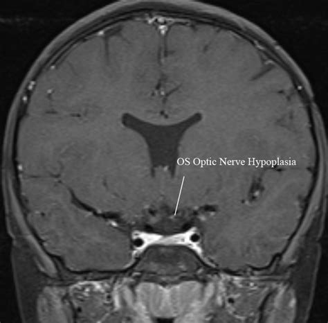 Unilateral Optic Nerve Hypoplasia in a patient desiring ...