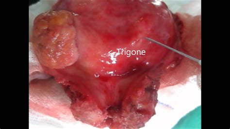 Urinary Bladder Showing Trigone And Bladder Tumor YouTube