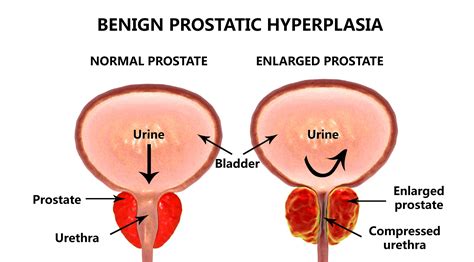 UroLift: New Relief From Enlarged Prostate | Health News Hub