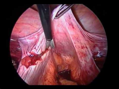 Urologia.Cistectomía radical laparoscópica con ...