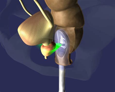 Urología Peruana: Dr. Susaníbar: Cáncer de próstata: tratamiento