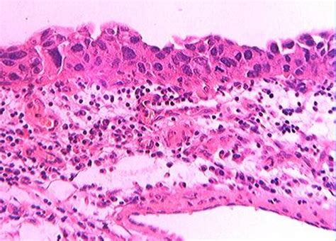Uropatología en Línea: Carcinoma Urotelial de Uréter, de ...