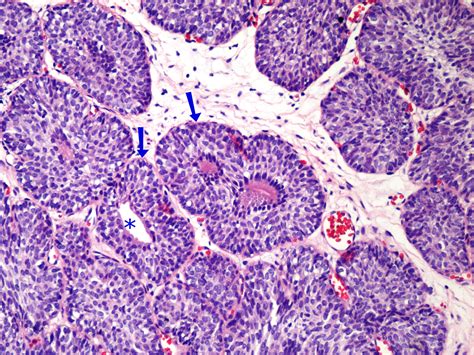 Uropatología en Línea: Papiloma de la Vejiga Urinaria