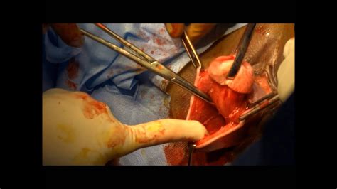 Vaginal Hysterectomy for prolapse uterus   YouTube