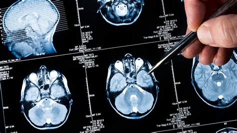 Vall d’Hebron estudia cómo controlar mejor los tumores cerebrales