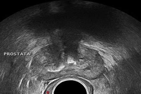 Valor diagnóstico del ultrasonido transrectal en el cáncer de próstata ...