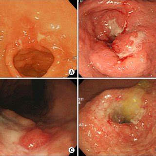 Variable gastroscopic findings of Borrmann type 4 advanced ...