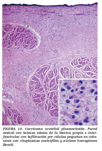 Variantes histológicas del carcinoma urotelial con ...