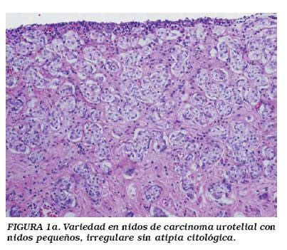 Variantes histológicas del carcinoma urotelial con ...