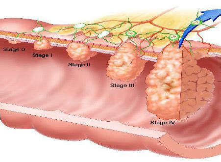 Various stages of colon cancer | Download Scientific Diagram