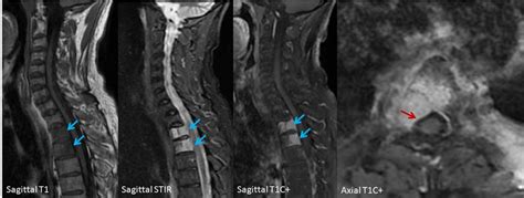 Vertebral metastasis in 58 year old man with Squamous cell ...