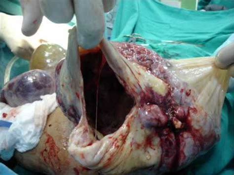 Very large tumor abdominal region.wmv   YouTube