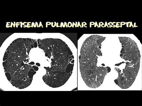Videoaula radiologia: Tomografia de tórax: Enfisema ...