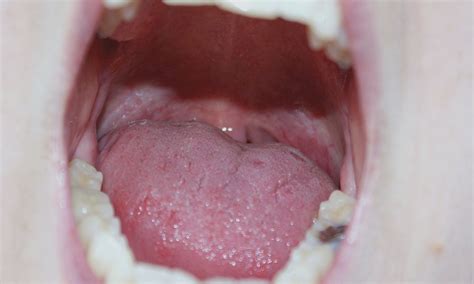 Virus de papiloma humano en boca y garganta Înțelesul ...