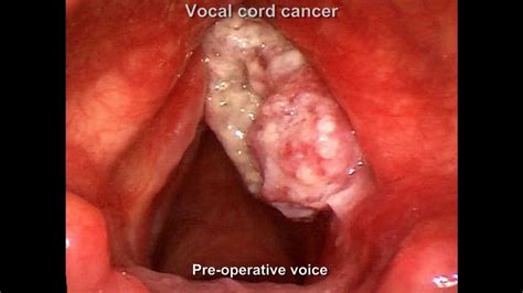 Vocal cord cancer treatment   MGH Voice Center   YouTube