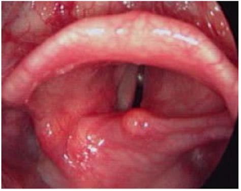 Vocal cord paralysis. Causes, symptoms, treatment Vocal ...