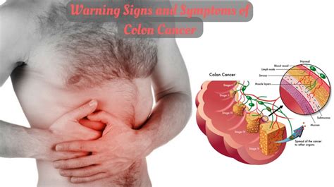 Warning Signs and Symptoms of Colon Cancer