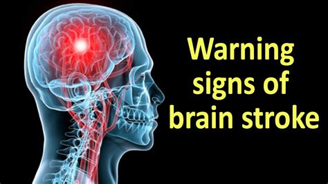 Warning Signs of Brain Stroke || Health Tips   YouTube