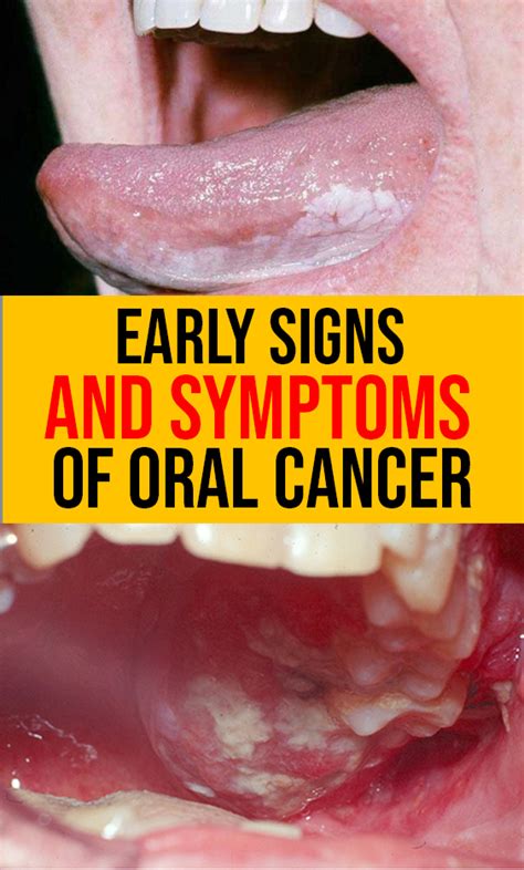Warning Signs Of Oral Cancer: Are You At Risk?   MEDICAL DAILY