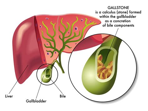 Westerville Surgical Specialists | Gallbladder Removal