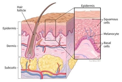 What Are Basal and Squamous Cell Skin Cancers?