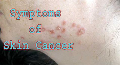 What are the Causes and Symptoms of Skin Cancer