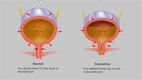 What Are the Causes of Overactive Bladder? | Everyday Health
