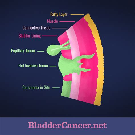 What are the Different Types of Bladder Cancer?