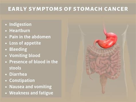 What are the early stage signs and symptoms of stomach ...