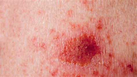 What are the Symptoms and Treatments for Skin Cancer ...