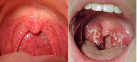 What are the symptoms of throat cancer?   Quora