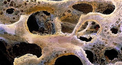 What Bone Metastasis Looks Like
