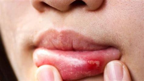 What Causes a Canker Sore & 13 Natural Ways to Heal It ...