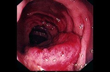 What Causes Colon Cancer In Men   Cancer News Update