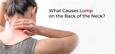 What Causes Lump on the Back of Neck? 5 Effective Home Remedies