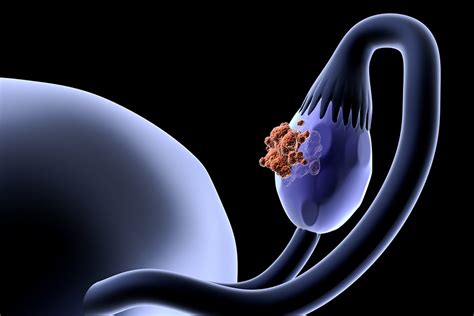 What causes ovarian cancer? New study suggests the root ...