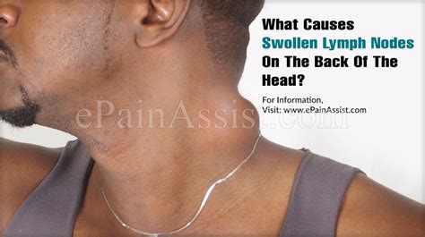 What Causes Swollen Lymph Nodes On The Back Of The Head?