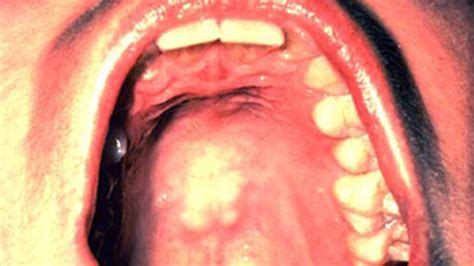 What Does Mouth Cancer Look Like? 5 Pictures of Mouth Cancer