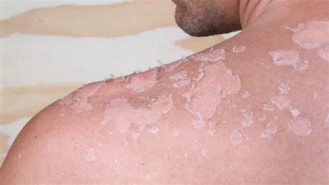 What Does Skin Cancer Look Like   CancerOz