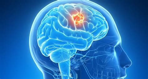 What Is A Brain Tumor :Malignant Brain Tumor | Trendingtop5