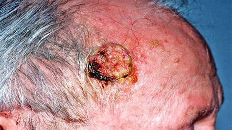 What is a Squamous Cell Carcinoma? SCC YouTube