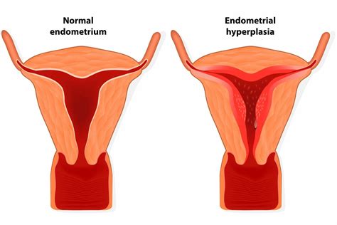 What is Atypical Endometrial Hyperplasia? | Nabta Health