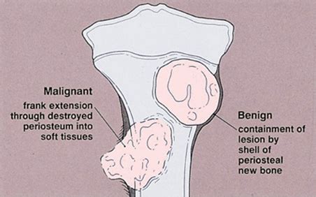 What is Benign and Malignant Bone Cancer / Soft Tissue Tumor?