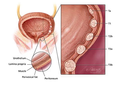 What is Bladder Cancer?   Urology Care Foundation