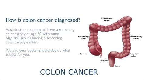What is colon cancer ?   YouTube