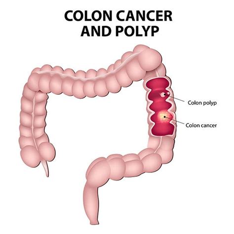 What is Colorectal Cancer? | Colorectal Cancer Alliance