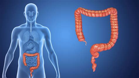 What is Colorectal Cancer?   YouTube