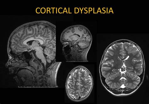 What Is Cortical Dysplasia? | EpilepsyU