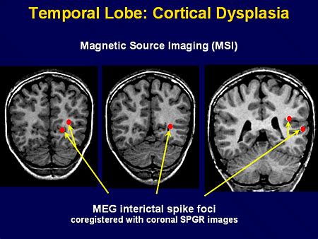 What Is Cortical Dysplasia?   EpilepsyU