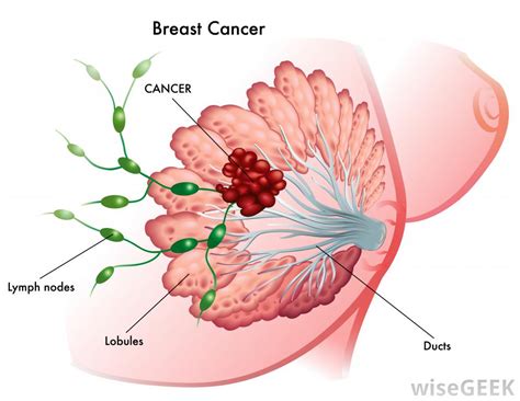 What Is Early Stage Breast Cancer?  with pictures